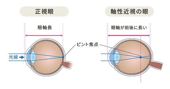 正常な目と近視の目の比較図